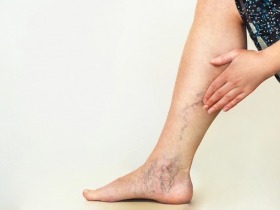 Křečové žíly v těhotenství – jak na prevenci?